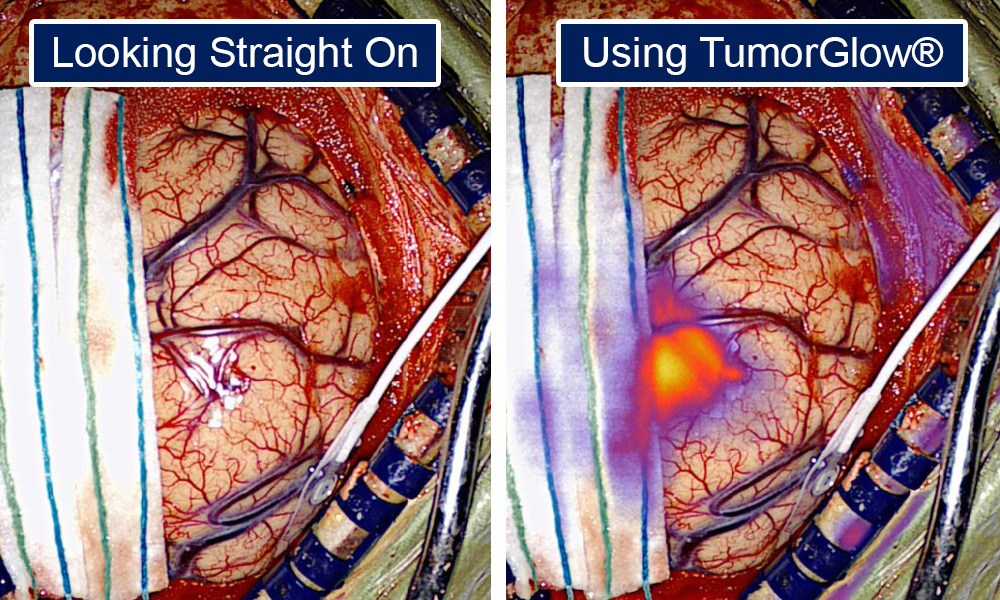 Comparing Naked Eye to TumorGlow